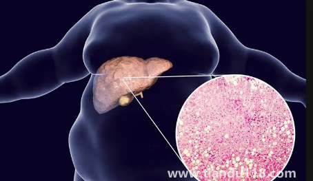 肝代謝不好吃什么調(diào)理3