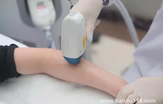 冰點(diǎn)脫毛的具體價(jià)格是多少錢（冰點(diǎn)脫毛一次能維持多久）