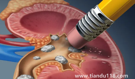腎結(jié)石3mm需要吃藥嗎3