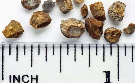 腎結(jié)石3mm需要治療嗎(腎結(jié)石3mm是多久形成的)(圖2) 腎結(jié)石3mm需要治療嗎2