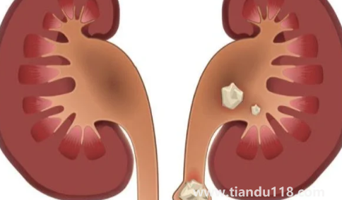 腎結石3mm×3mm多大(雙腎3×3mm小結石怎么辦)(圖2) 腎結石3mm×3mm多大2