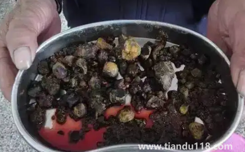 腎結石3mm×3mm多大(雙腎3×3mm小結石怎么辦)(圖3) 腎結石3mm×3mm多大3